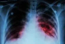 Alarma por cuatro casos de Tuberculosis en la región: “Es muy contagioso”
