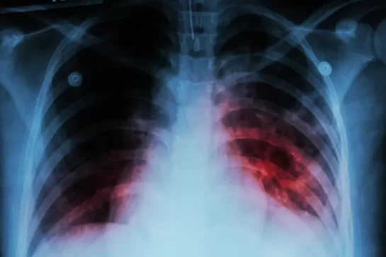 Alarma por cuatro casos de Tuberculosis en la región: «Es muy contagioso»