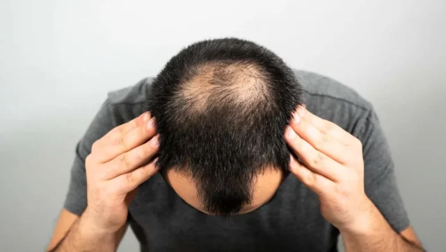 Posible cura para la calvicie en apenas 20 días sorprende a los especialistas