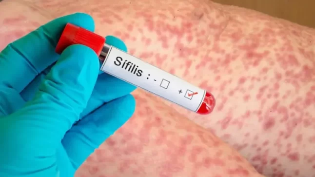 Sífilis, la enfermedad silenciosa que suma casos en Río Negro: síntomas, tratamiento y números